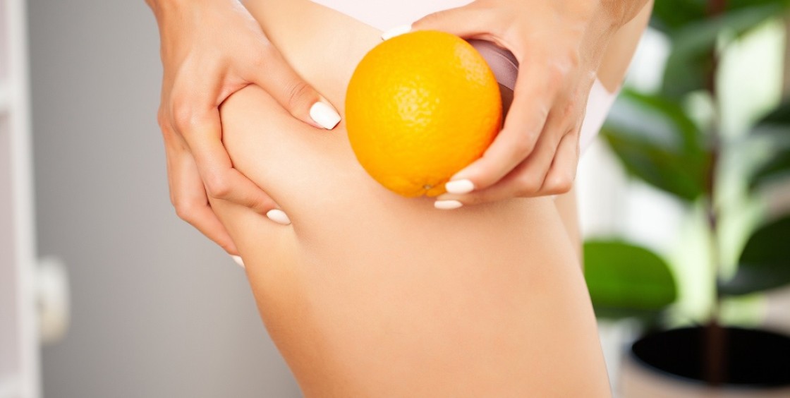 Celulitis: la piel de naranja que no es una enfermedad