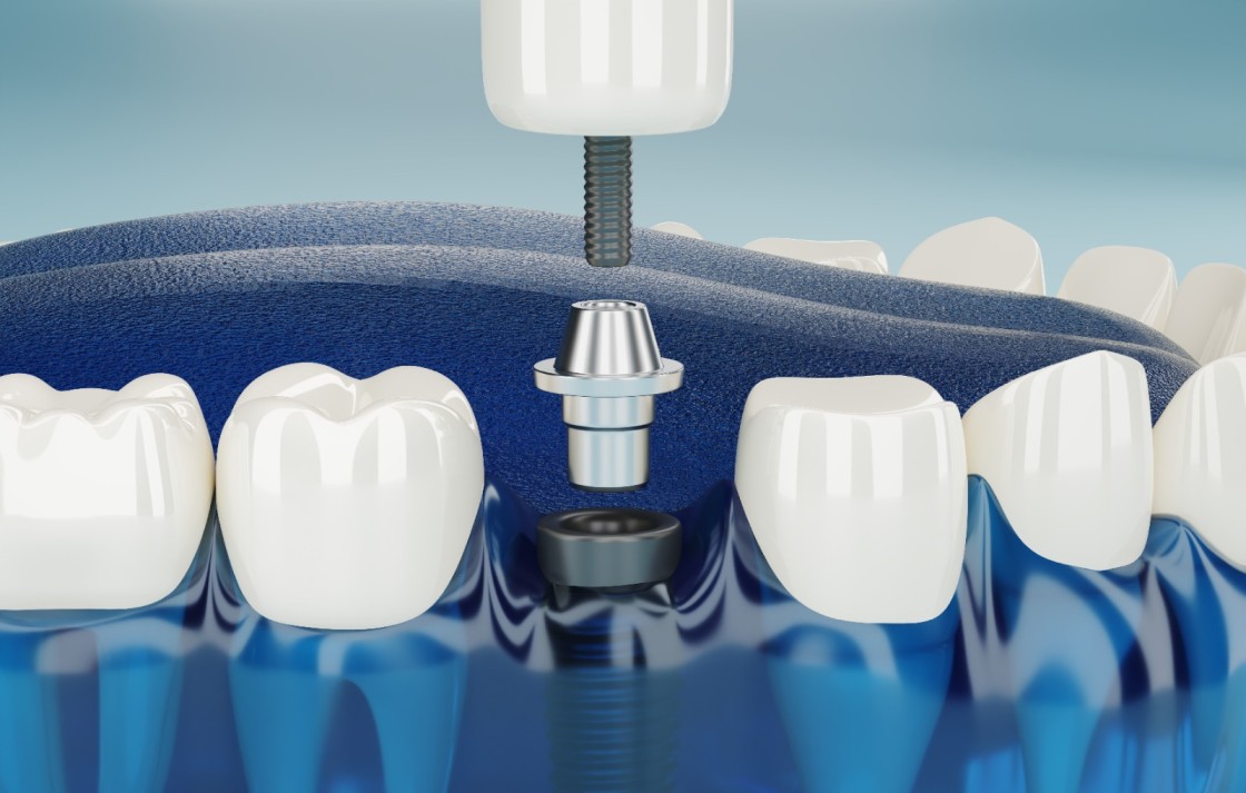 TODA LA INFORMACIÓN QUE NECESITAS SABER ANTES DE PONERTE LOS IMPLANTES DENTALES