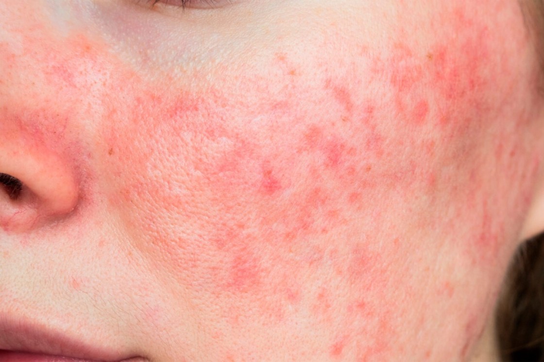 “No, no me da vergüenza… es rosácea”