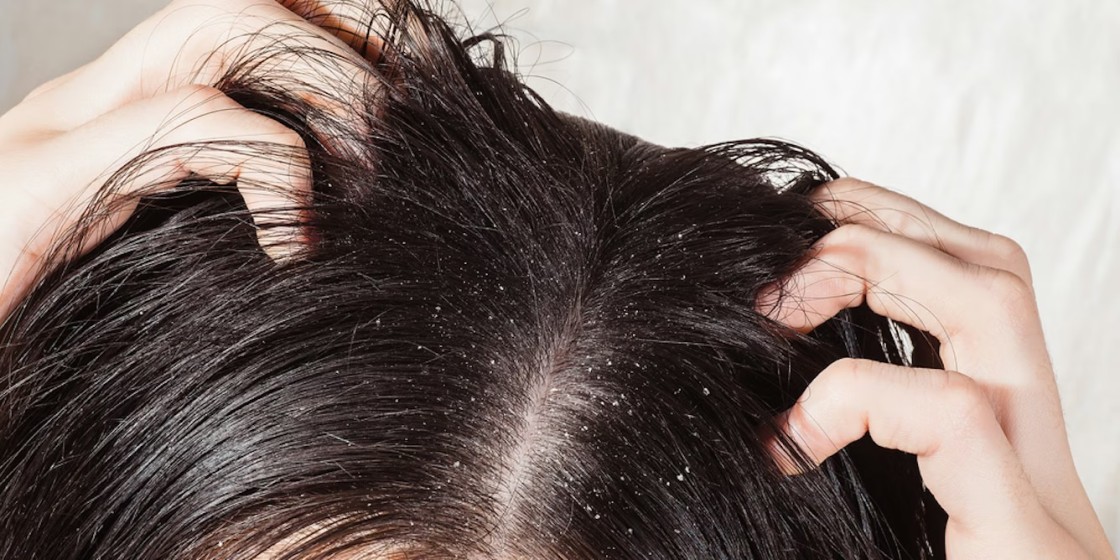 Cuando la cabeza protesta sin avisar:  por qué pica el cuero cabelludo aunque esté limpio