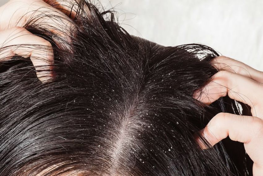 Cuando la cabeza protesta sin avisar:  por qué pica el cuero cabelludo aunque esté limpio