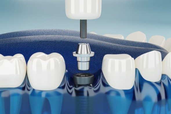 TODA LA INFORMACIÓN QUE NECESITAS SABER ANTES DE PONERTE LOS IMPLANTES DENTALES