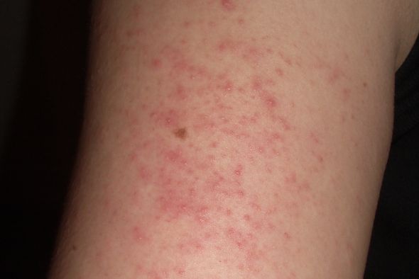 Doctor, tengo la piel como de gallina… pero siempre