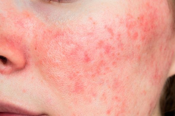 “No, no me da vergüenza… es rosácea”
