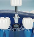 TODA LA INFORMACIÓN QUE NECESITAS SABER ANTES DE PONERTE LOS IMPLANTES DENTALES